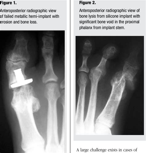 Figure From Distraction First Metatarsophalangeal Arthrodesis With