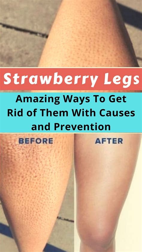 Strawberry Legs 10 Amazing Ways To Get Rid Of Them With Causes And