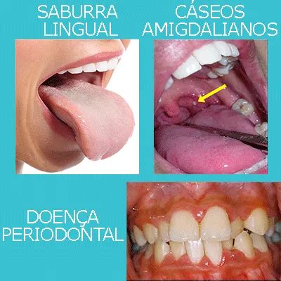 Causas do Mau Hálito Saiba de onde vem a Halitose