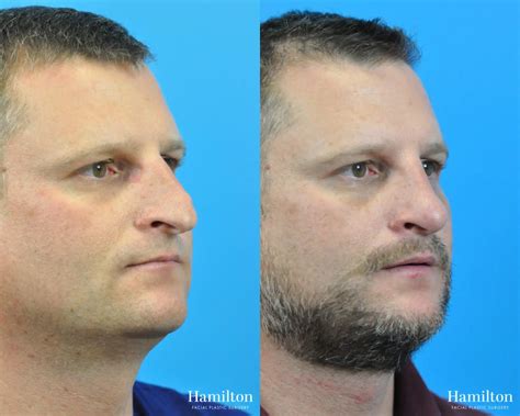 Rhinoplasty Before And After Gallery Patient 30