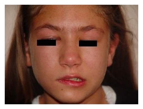 Grade 4 Peripheral Facial Paralysis On The Right Download Scientific