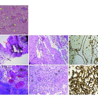 | Histology images of donor and recipient lesions. (A) Histology image ...