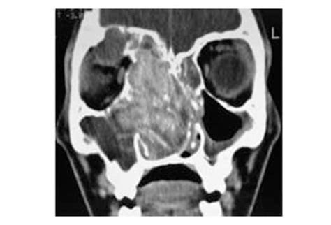 Allergic Fungal Sinusitis Slideshow