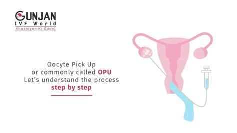 Opu Pickup How Is It Done Gunjan Ivf World