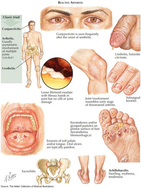 Keratoderma Blennorrhagicum