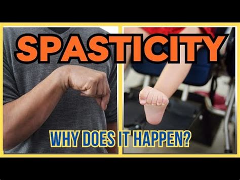 Spasticity Simplified What You Need To Know YouTube