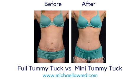 Full Tummy Tuck Vs Mini Tummy Tuck Youtube