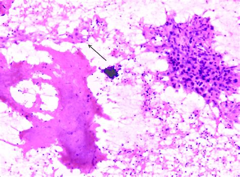 Fine Needle Aspiration Cytology Showing An Epithelioid Cell Granuloma