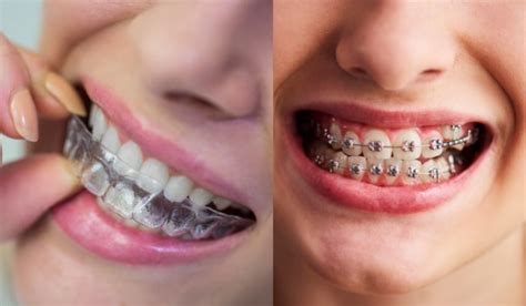 Clear Aligners Vs Traditional Braces Choosing The Right One