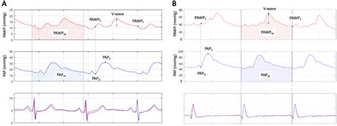 Pulmonary Artery Wedge Waveform