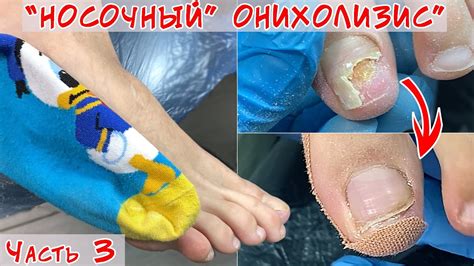 Онихолизис ногтей / Часть 3 / Носочный онихолизис - YouTube