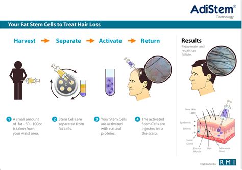 Treatment for Hair Restoration | Stem Cell Therapy for Hair Restoration