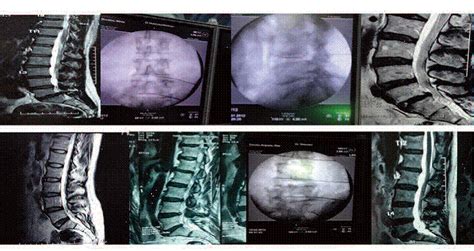 Estudio Demuestra Xito Del Ozono En Tratamiento De Hernia Discal