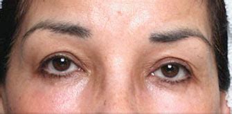 Dark Circles Surgery Beverly Hills | How To Get Rid of Eye Bags