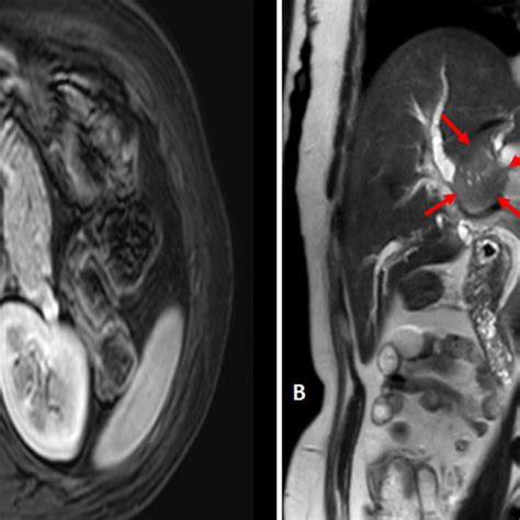 (PDF) Klatskin tumor presenting as unresectable perihilar hepatic mass ...