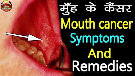 मुँह के कैंसर के लक्षण कारण और समाधान Mouth Cancer Symptoms And