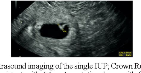 Figure 1 From A Ruptured Spontaneous Heterotopic Tubal Pregnancy With A