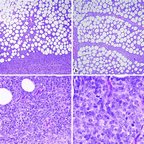 A The Pleural Biopsy Showed Sheets Of Small Round Blue Cells That