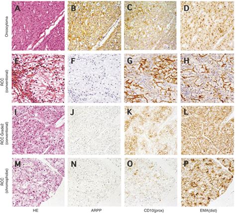 Specific Expression Of Arpp In Renal Oncocytoma Serial Tissue Sections