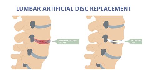 Lumbar Artificial Disc Replacement Orange County Ca