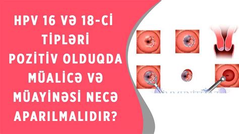 HPV 16 VƏ 18-Cİ TİPLƏRİ POZİTİV OLDUQDA MÜAYİNƏ VƏ MÜALİCƏSİ NECƏ ...