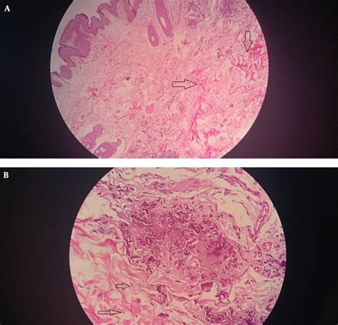 A Hematoxylin And Eosin Stain 10x View Showing Fragmented Elastin