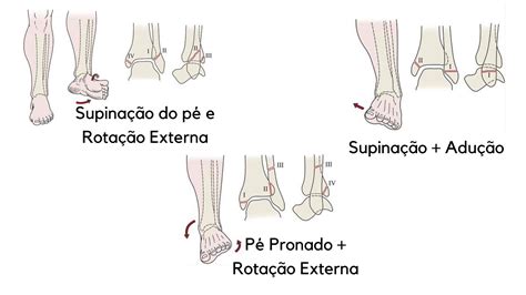 Fratura Do Tornozelo Quando Operar Medicina Ortopédica