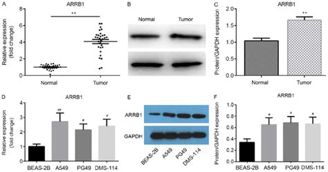 Arrb Expression Levels Are Upregulated In Nsclc Tissues And Cells