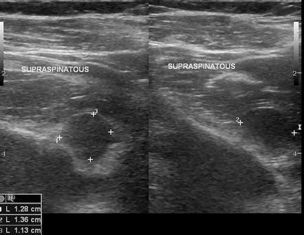 Shoulder Anatomy Ultrasound