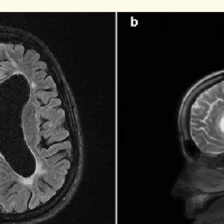 A Axial Flair T Weighted Mri And B Sagittal T Weighted Mri Image