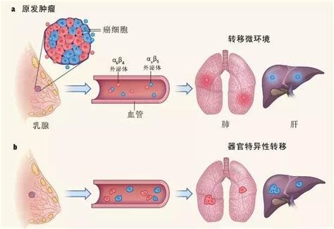 宣晟远程会诊警惕肿瘤患者出现这6大征兆可能是复发转移