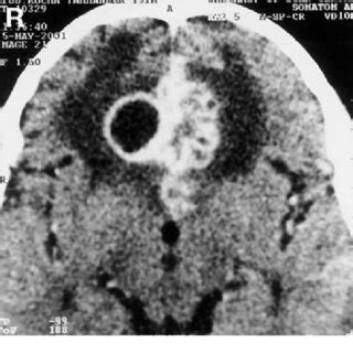 Axial Computed Tomography Scan With Contrast Medium Showing A