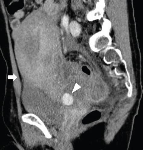 Contrast Enhanced Computed Tomographic Images A Axial Image And B