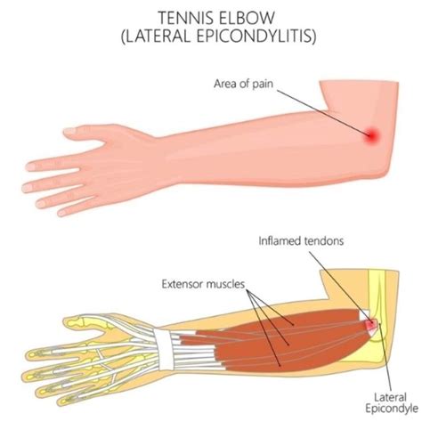 Physical Solutions Elbow Pain Affecting Your Game Physical Solutions