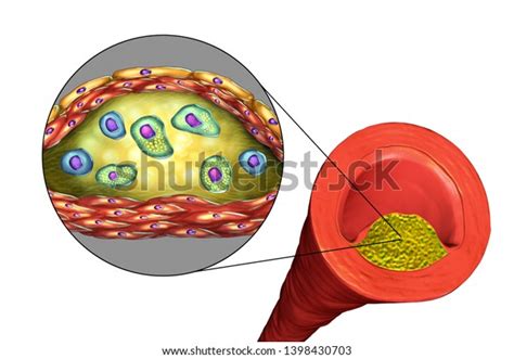 Structure Atherosclerotic Plaque Illustration Showing Necrotic