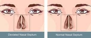 Deviated nasal septum: Causes - NAMAT blog