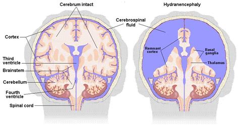 Information Rays Of Sunshine Hydranencephaly Support And Information