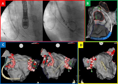 D Visualization Of The Steerable Guiding Sheath Enabling The Ablation