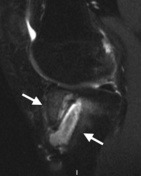 Mr Imaging Of Complications Of Anterior Cruciate Ligament Graft