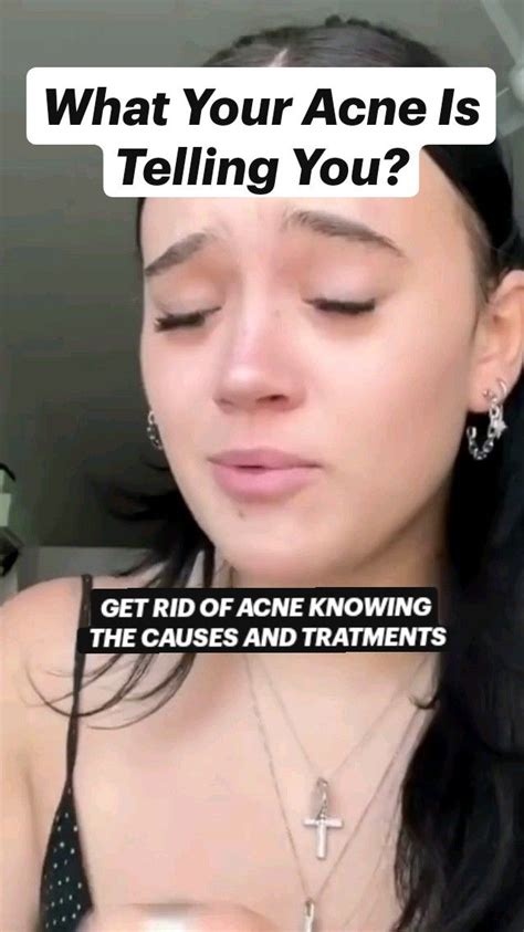 What Your Acne Is Telling You Get Rid Of Acne Knowing The Causes And