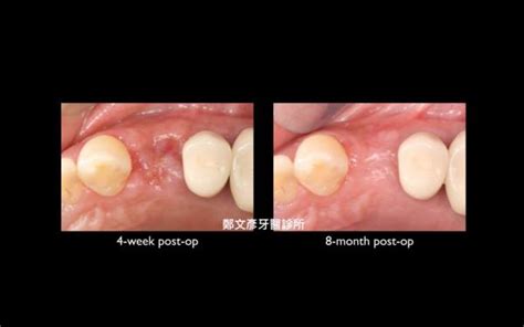 Role Of Granulation Tissue In Socket Preservation 鄭文彥牙醫診所的部落格 Udn部落格