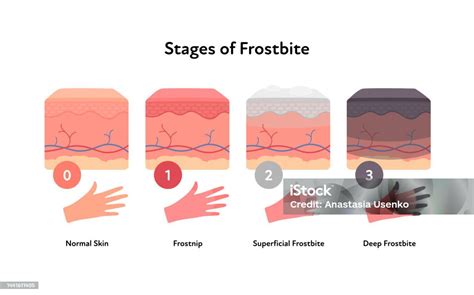 Frostbite Anatomical Infographic Vector Flat Healthcare Illustration