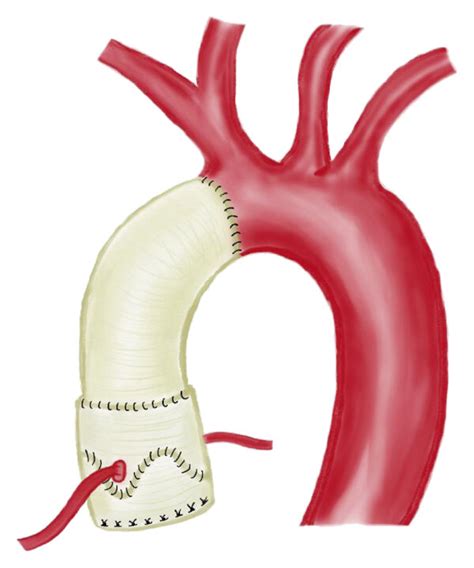 Illustration Of Valve Sparing Aortic Root And Ascending Aorta