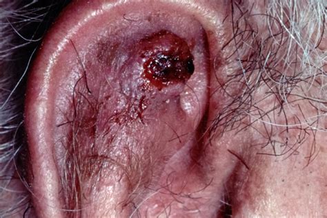 Squamous Cell Carcinoma Ear