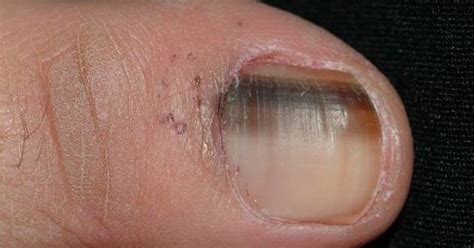 Nail Melanoma Know The Signs The Senior Senior