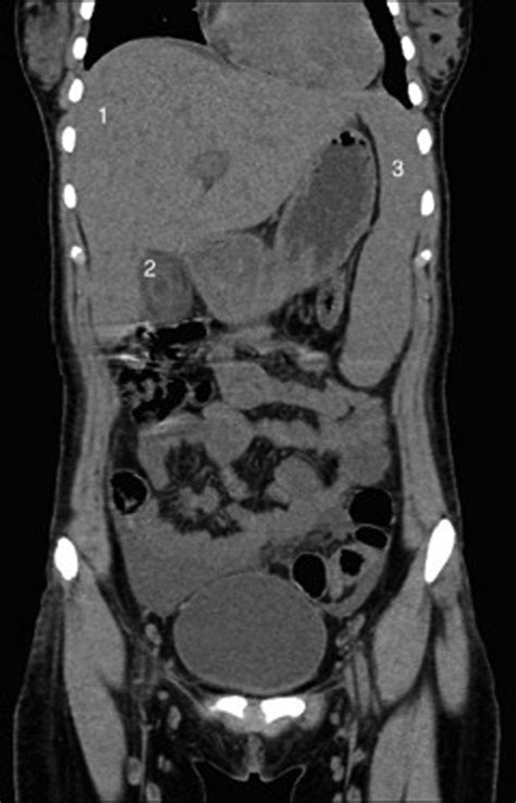 Acute Acalculous Cholecystitis In A Lebanese Girl With Primary Epstein Barr Viral Infection