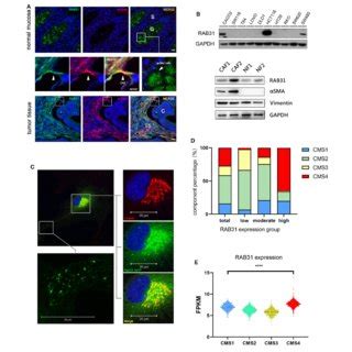 HGF MET Signaling Blockade Abolishes Colon Cancer Cell Migration