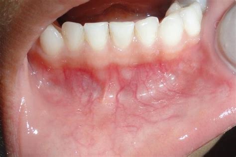 Oral Mucocele: A Case Report. (PDF Download Available)