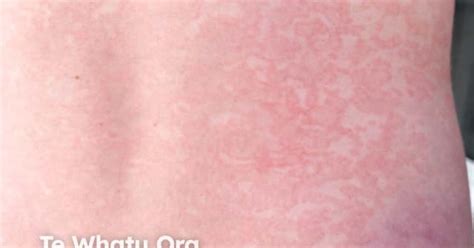 Drug Induced Urticaria Image