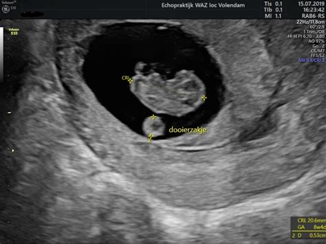Termijnecho Echopraktijk WAZ Echo S Tijdens Je Zwangerschap